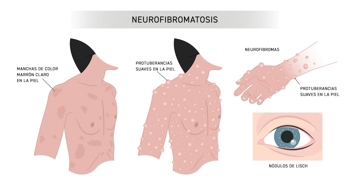 neurofibromatosis tipo 1 nódulos de lisch