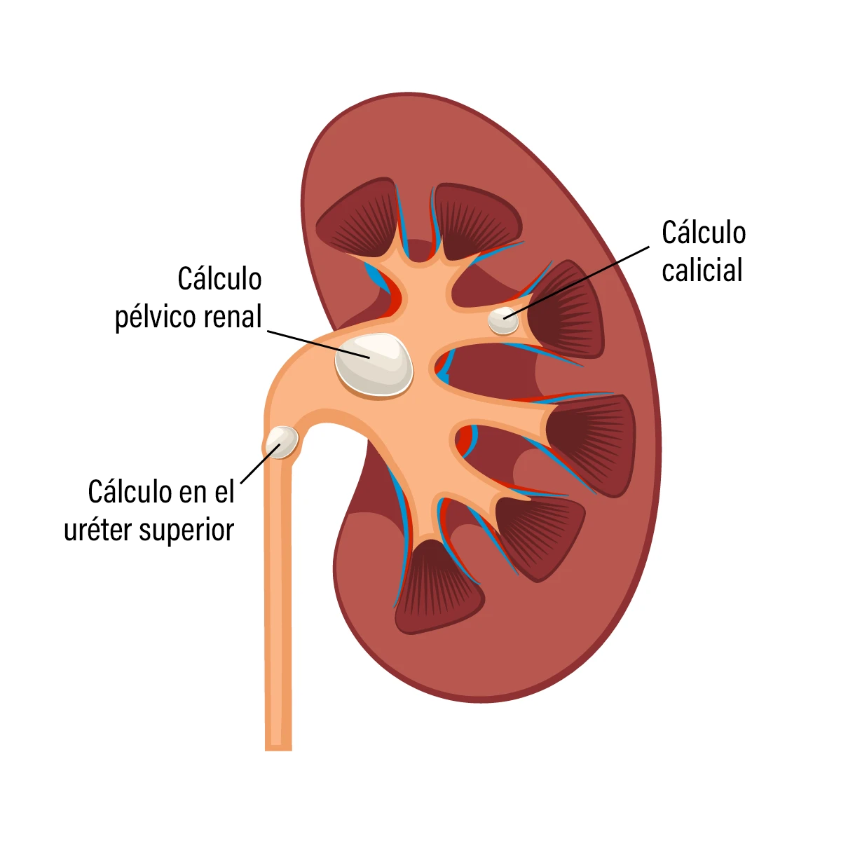 Cálculos ureterales Causas, tratamiento y prevención Advocate Health